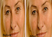 make your five photos wrinkle or acne free using photoshop small2