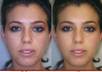 remove acne, scars and other skin impurities from your picture using Photoshop small3