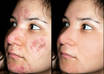 remove Blemishes From a Face Using Photoshop small1