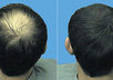 tell you how to Grow your Hair Back Naturally with my Proven Secret