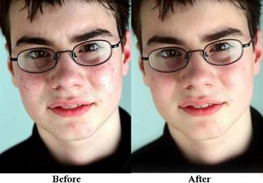 remove acne, scars and other skin impurities from your picture using Photoshop big1