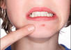 remove your pimples from one photo