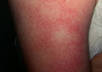 send you my secret to beating embarrassing keratosis pilaris and mild eczema